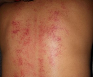 Gua sha en la espalda